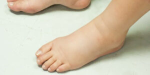 Kaki Bengkak Saat Hamil