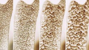 Osteoporosis
