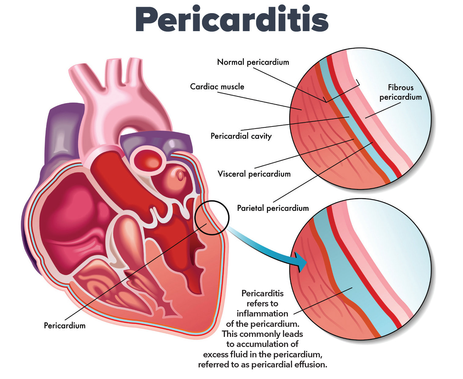 perikarditis