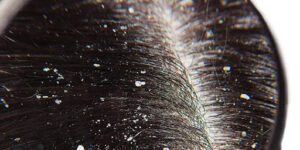 Mengatasi Ketombe: Solusi Ampuh dan Alami untuk Kulit Kepala Sehat Mengatasi Ketombe